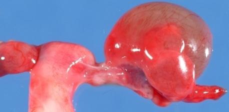 ingrandimento uterino 